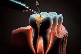 Endodoncia- Clínica dental Santa Ana