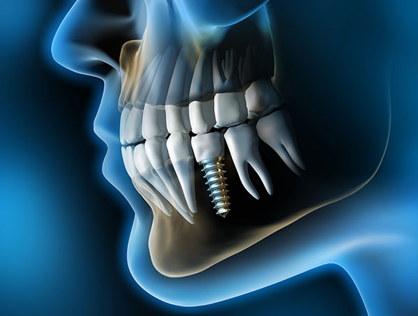 implantes dentales - Clínica dental Santa Ana