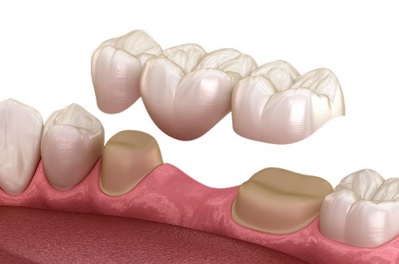 prostodoncia - Clínica dental Santa Ana